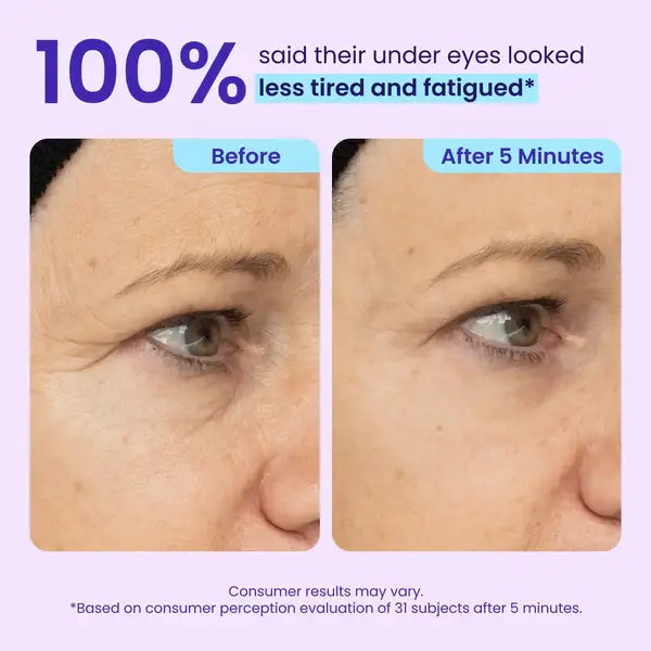 💥LAST DAY SALE-60% OFF- Ovelisy® Eye Bag Instant Eraser, Tightens, Firms, & Blurs Wrinkles