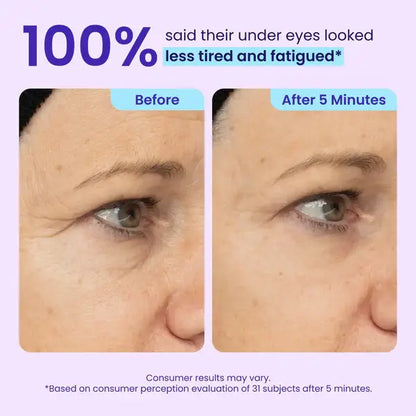 💥LAST DAY SALE-60% OFF- Ovelisy® Eye Bag Instant Eraser, Tightens, Firms, & Blurs Wrinkles
